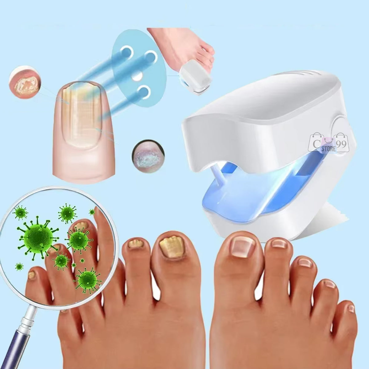 Laser Nail Pro® - Dispositivo láser para tratamiento de hongos en las uñas